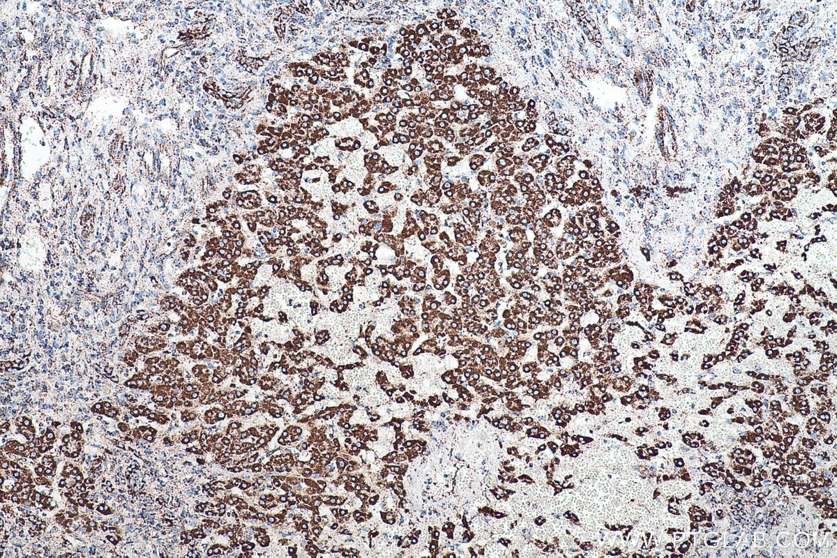 Immunohistochemical analysis of paraffin-embedded human liver cancer tissue slide using KHC0510 (ATP5B IHC Kit).