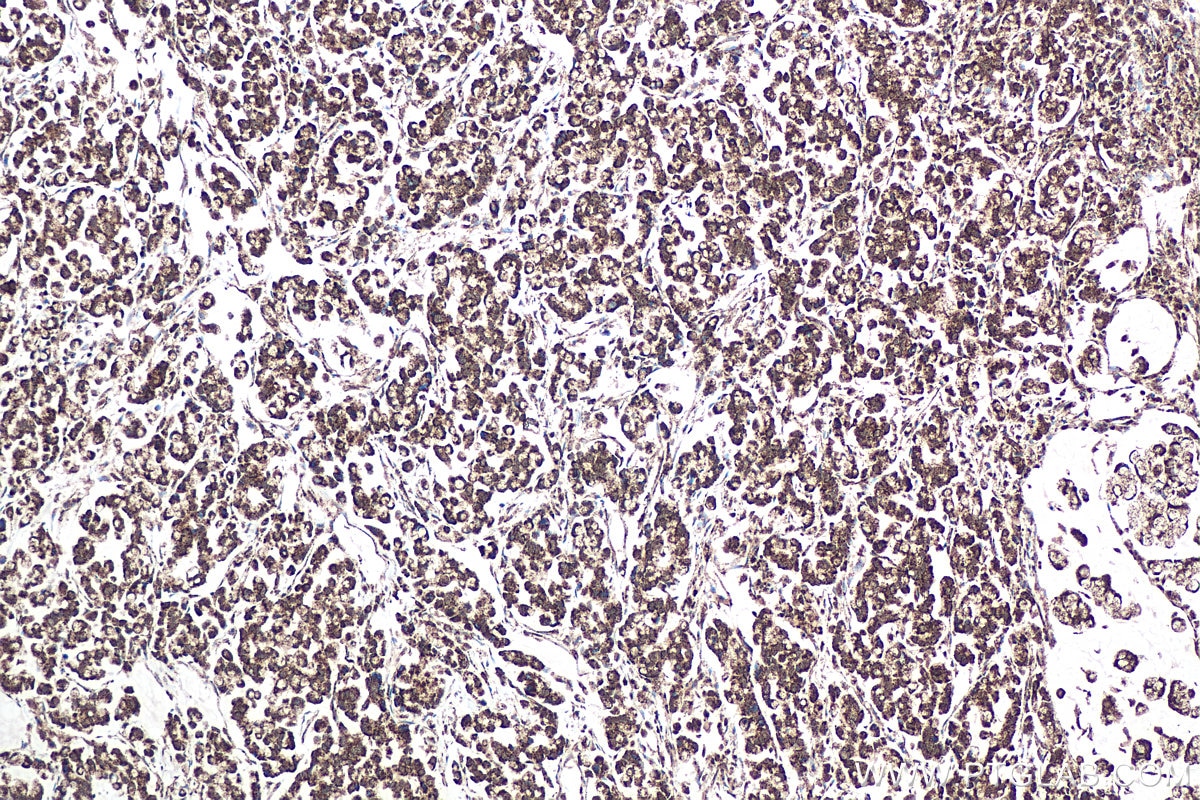 Immunohistochemical analysis of paraffin-embedded human colon cancer tissue slide using KHC0960 (ATP5D IHC Kit).