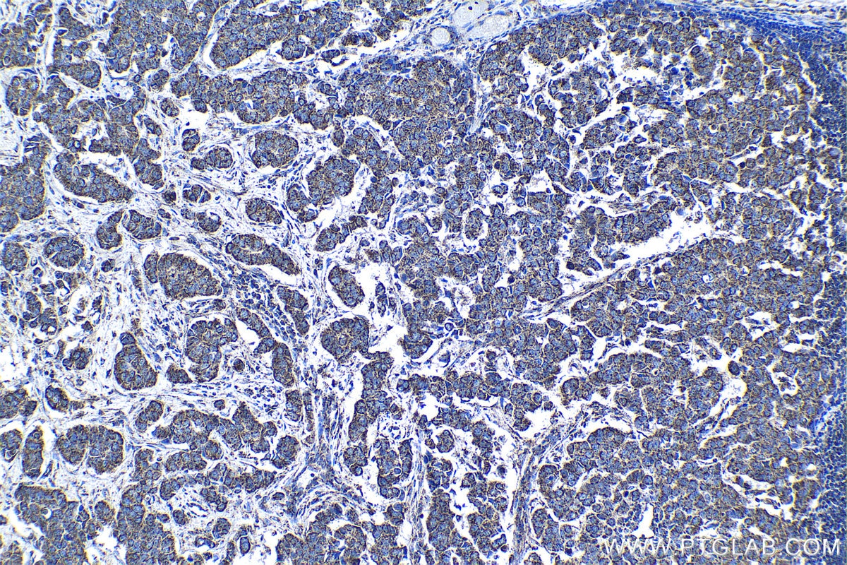Immunohistochemical analysis of paraffin-embedded human breast cancer tissue slide using KHC1353 (ATP5J IHC Kit).