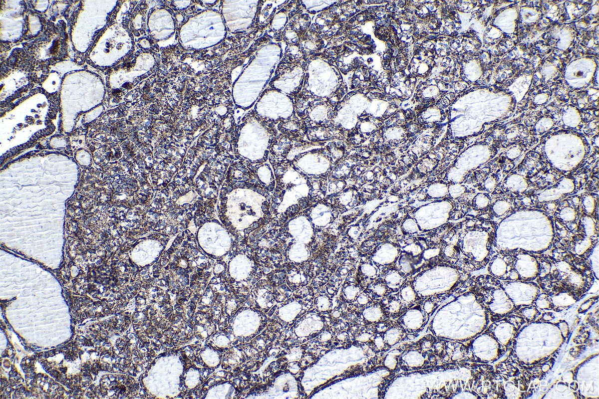 Immunohistochemical analysis of paraffin-embedded human thyroid cancer tissue slide using KHC1353 (ATP5J IHC Kit).