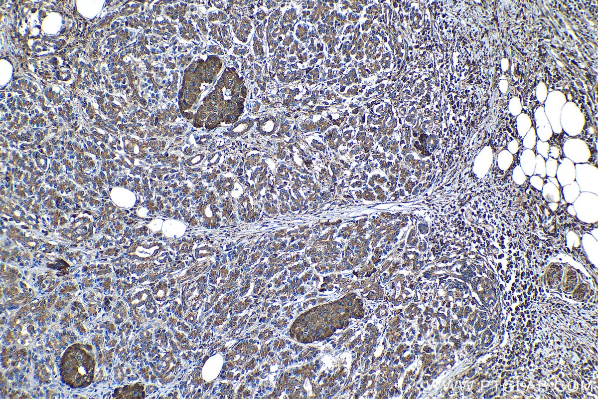 Immunohistochemical analysis of paraffin-embedded human pancreas cancer tissue slide using KHC1354 (ATP6V1E1 IHC Kit).