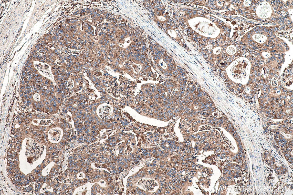 Immunohistochemical analysis of paraffin-embedded human stomach cancer tissue slide using KHC0959 (ATP6V1G1 IHC Kit).
