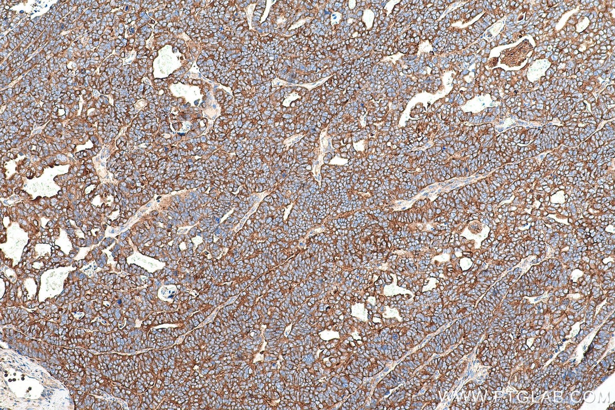 Immunohistochemical analysis of paraffin-embedded human ovary tumor tissue slide using KHC0959 (ATP6V1G1 IHC Kit).