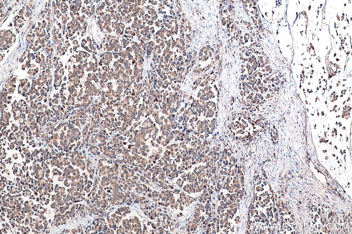 Immunohistochemical analysis of paraffin-embedded human colon cancer tissue slide using KHC0959 (ATP6V1G1 IHC Kit).