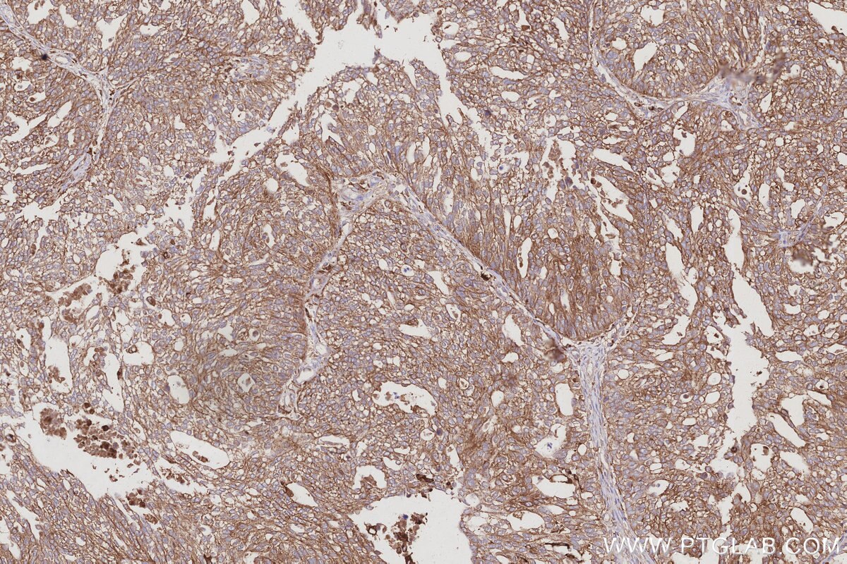 Immunohistochemical analysis of paraffin-embedded human ovary cancer tissue slide using KHC3027 (ATP6V1H IHC Kit). Immunohistochemical analysis of paraffin-embedded human ovary cancer tissue slide using KHC3027 (ATP6V1H IHC Kit).