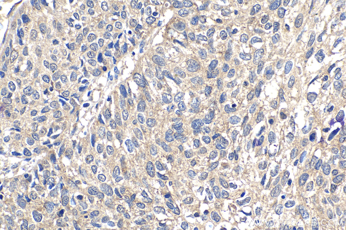 Immunohistochemical analysis of paraffin-embedded human cervical cancer tissue slide using KHC2064 (AURKA IHC Kit).