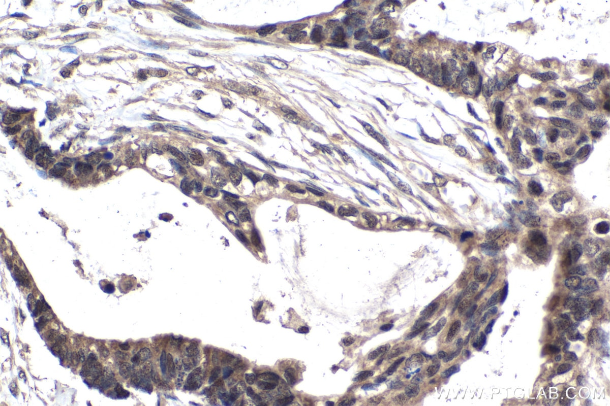 Immunohistochemical analysis of paraffin-embedded human urothelial carcinoma tissue slide using KHC1440 (AXIN1 IHC Kit).