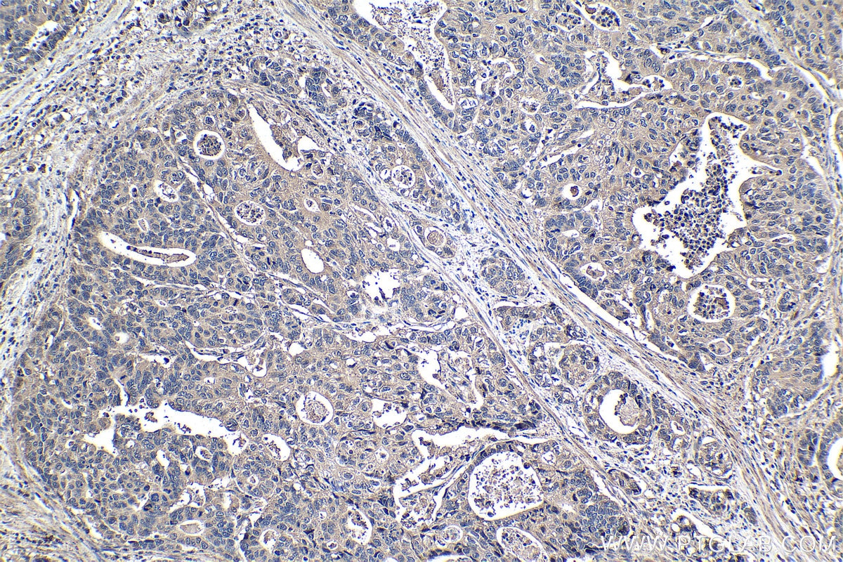 Immunohistochemical analysis of paraffin-embedded human stomach cancer tissue slide using KHC1440 (AXIN1 IHC Kit).