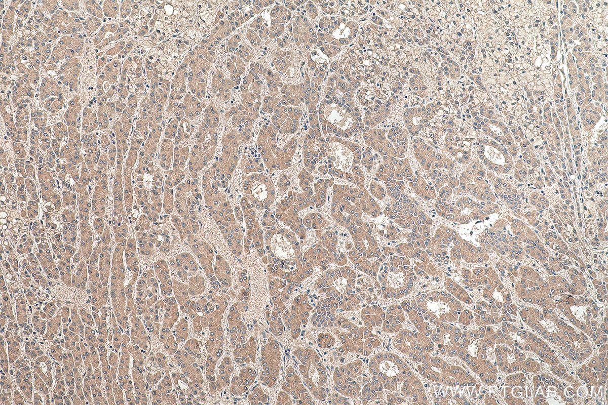 Immunohistochemical analysis of paraffin-embedded human liver cancer tissue slide using KHC0401 (AZGP1 IHC Kit).