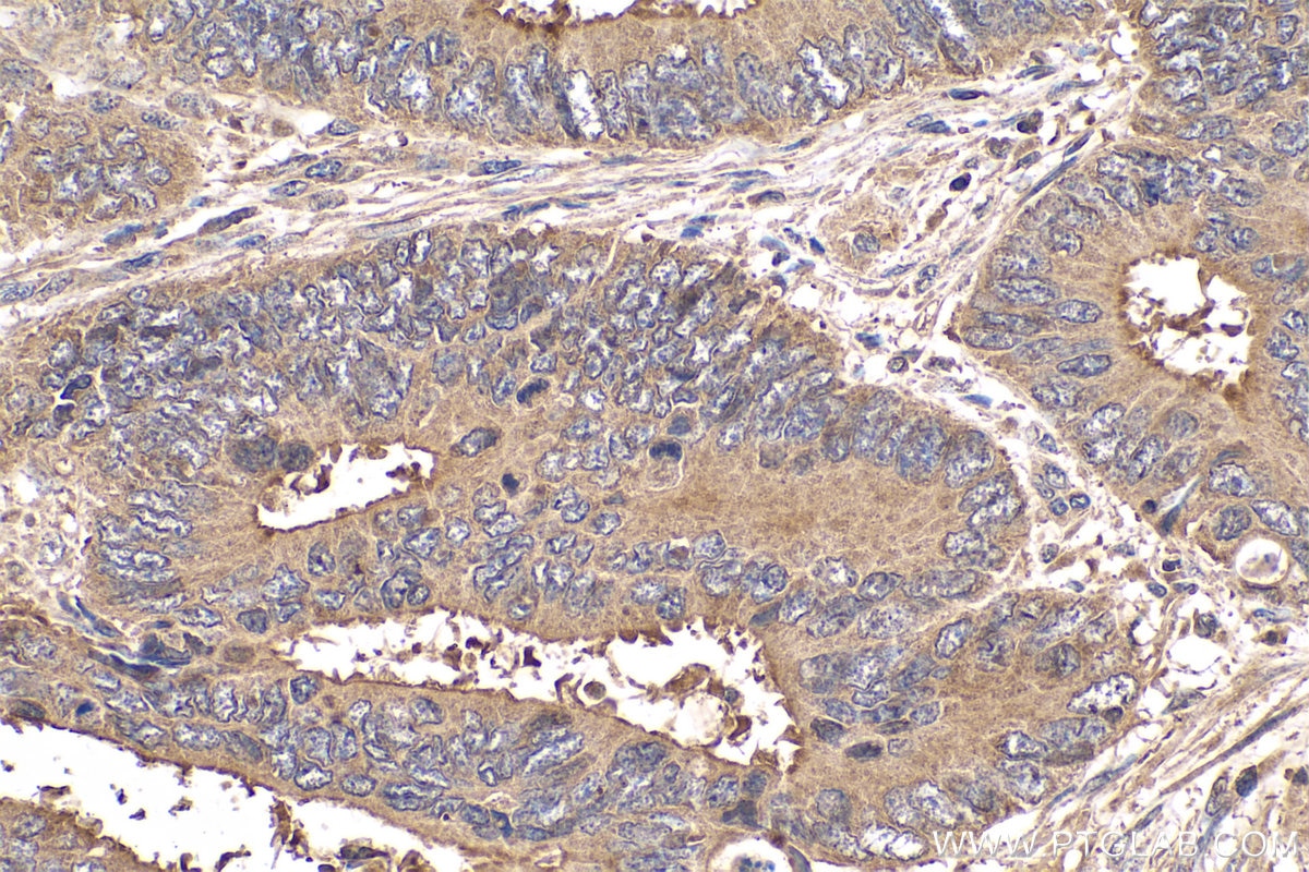 Immunohistochemical analysis of paraffin-embedded human colon cancer tissue slide using KHC0401 (AZGP1 IHC Kit).