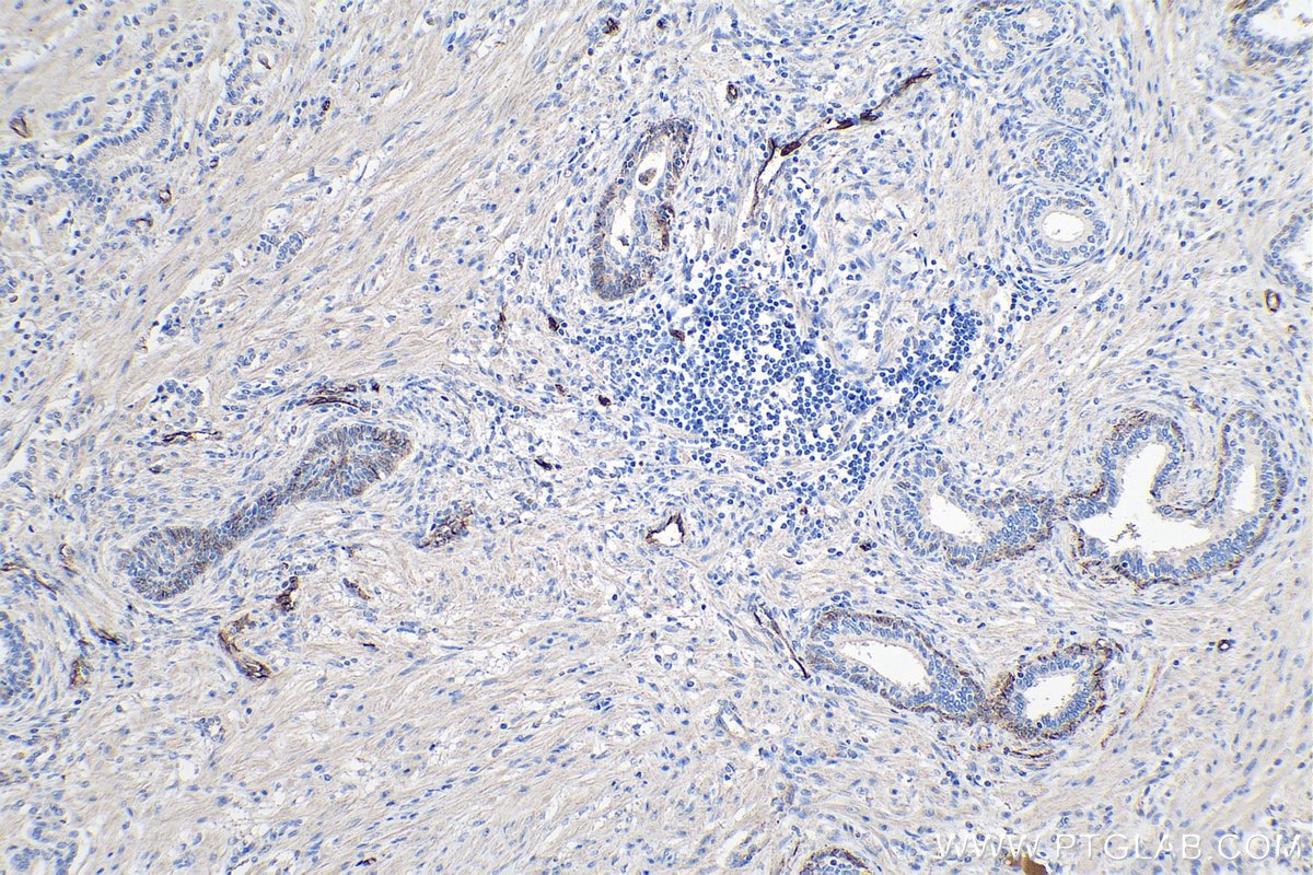 Immunohistochemical analysis of paraffin-embedded human prostate cancer tissue slide using KHC0240 (Adiponectin IHC Kit).