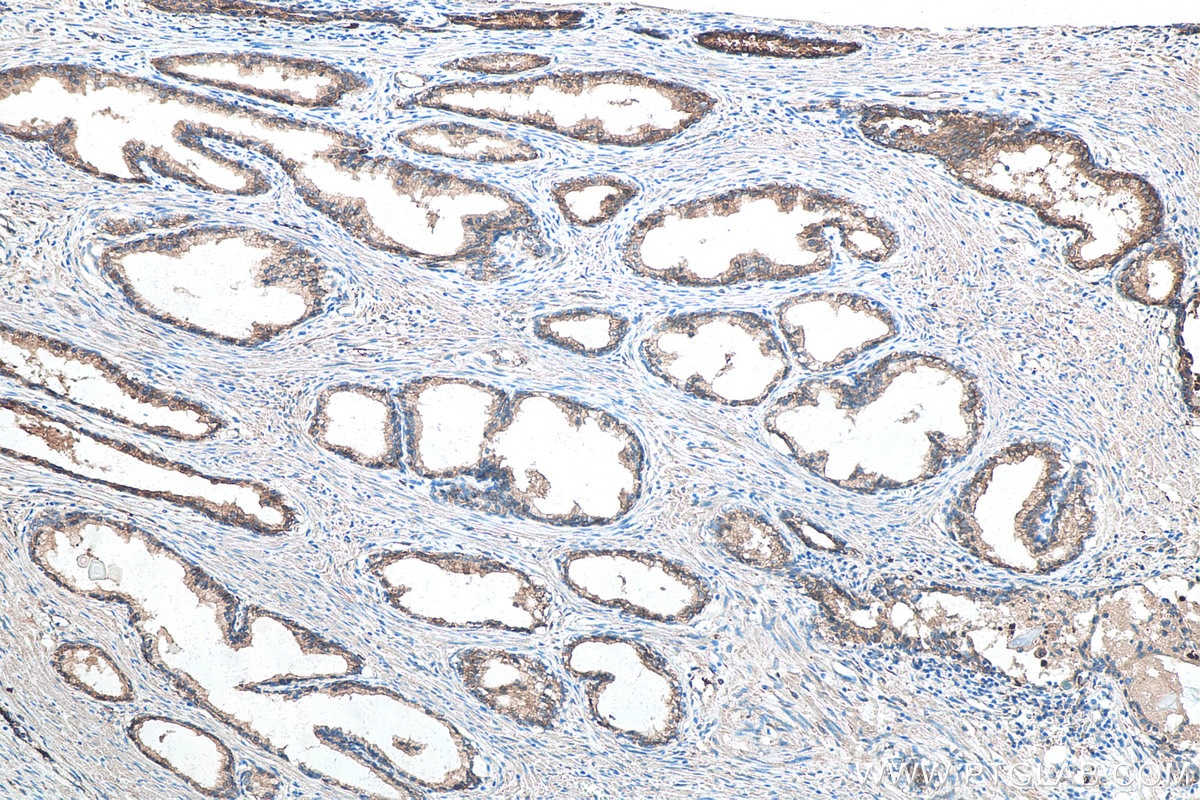 Immunohistochemical analysis of paraffin-embedded human prostate cancer tissue slide using KHC0088 (Alpha Actinin IHC Kit).
