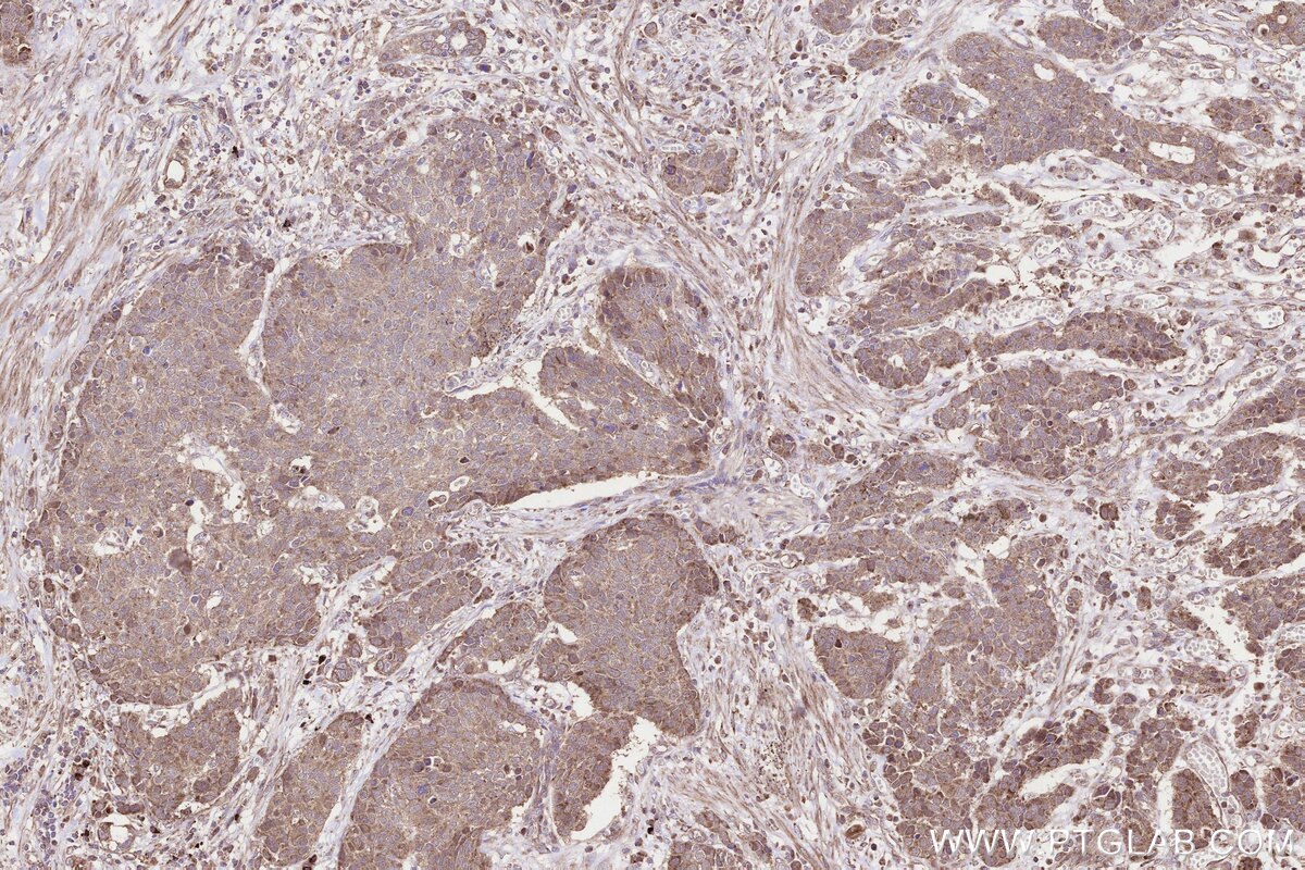 Immunohistochemical analysis of paraffin-embedded human stomach cancer tissue slide using KHC3299 (B3GNT7 IHC Kit).