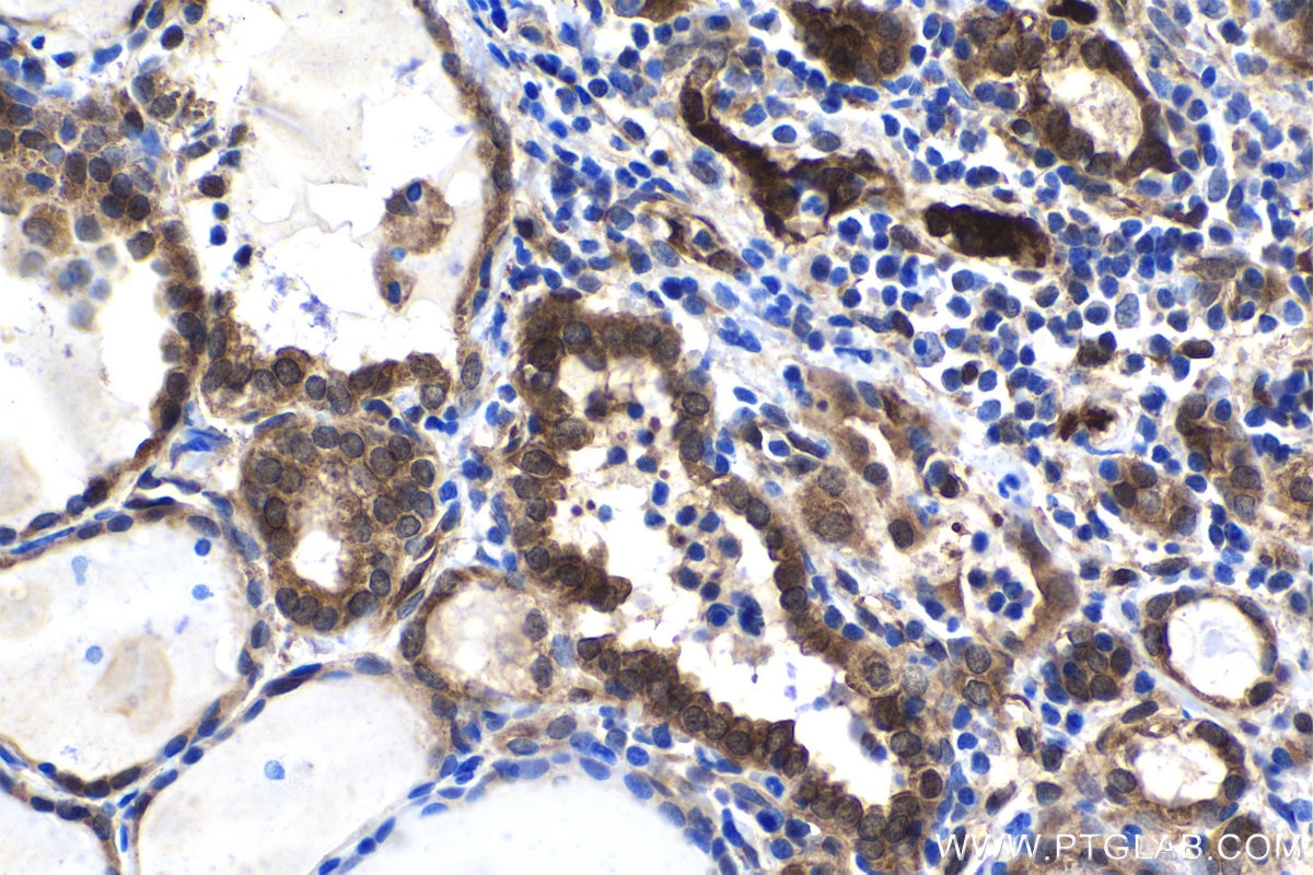 Immunohistochemical analysis of paraffin-embedded human thyroid cancer tissue slide using KHC1500 (BAG3 IHC Kit).
