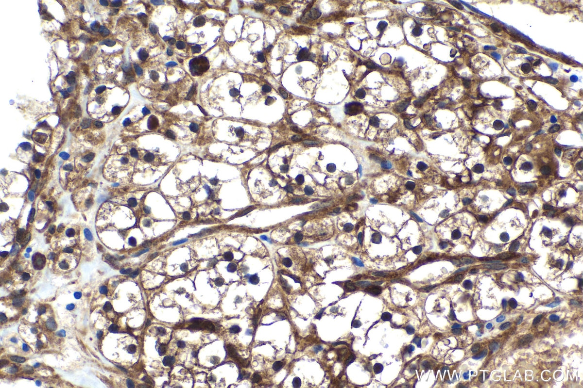 Immunohistochemical analysis of paraffin-embedded human renal cell carcinoma tissue slide using KHC1500 (BAG3 IHC Kit).