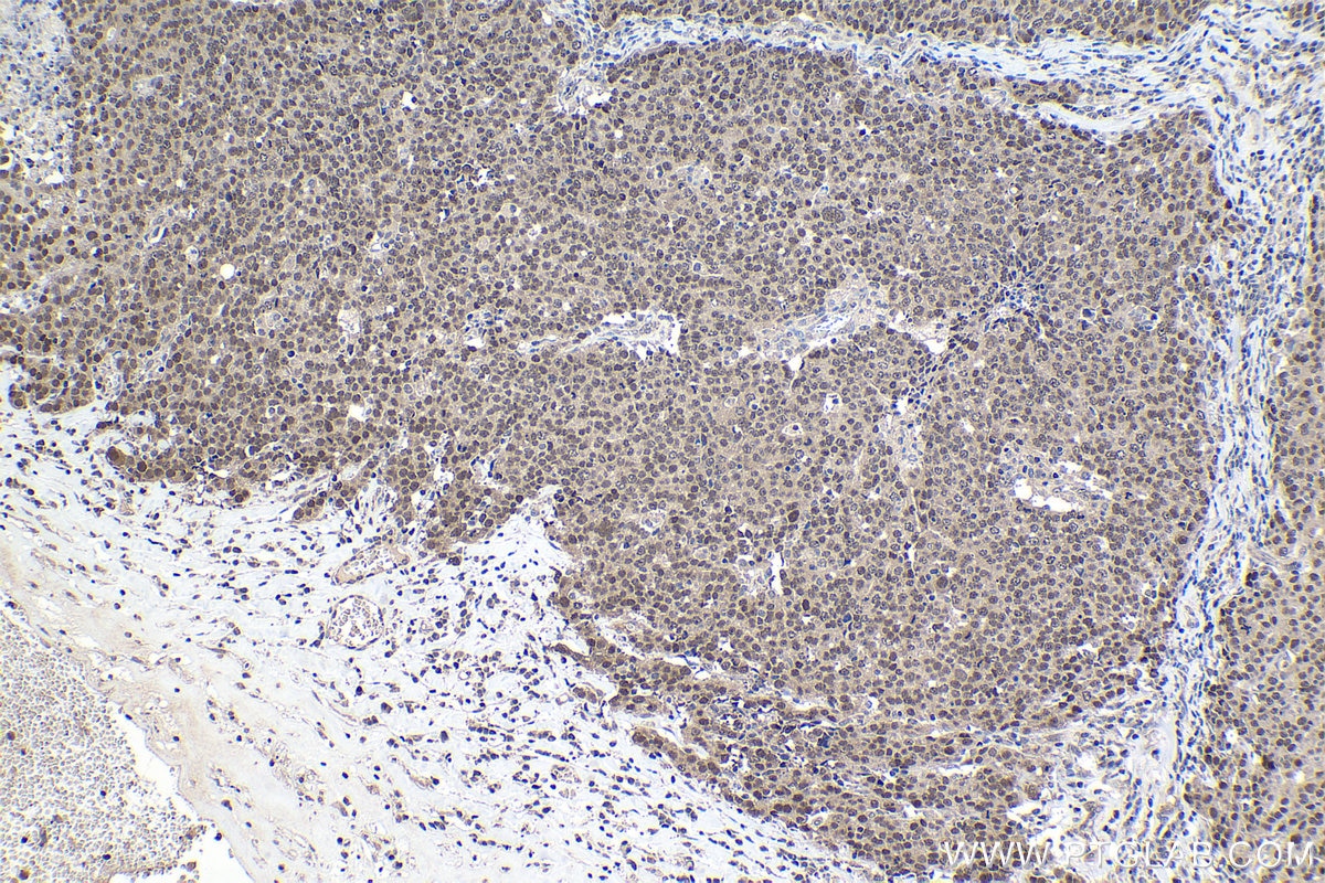 Immunohistochemical analysis of paraffin-embedded human ovary tumor tissue slide using KHC1031 (BAG5 IHC Kit).