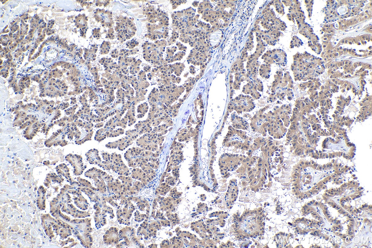 Immunohistochemical analysis of paraffin-embedded human thyroid cancer tissue slide using KHC1031 (BAG5 IHC Kit).