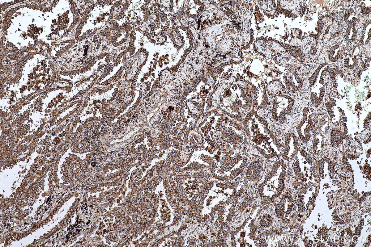 Immunohistochemical analysis of paraffin-embedded human lung cancer tissue slide using KHC0605 (BAK IHC Kit).