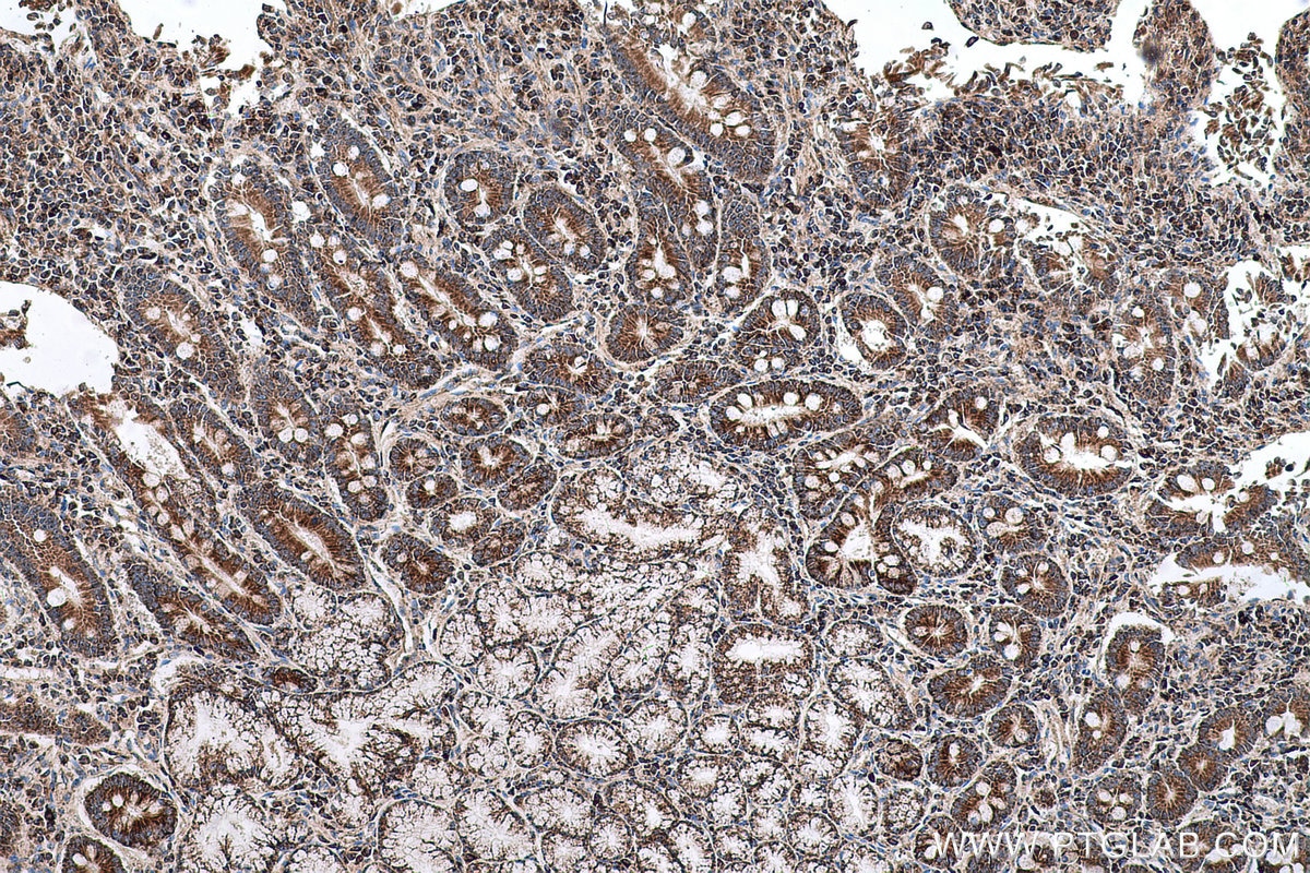 Immunohistochemical analysis of paraffin-embedded human stomach cancer tissue slide using KHC0605 (BAK IHC Kit).