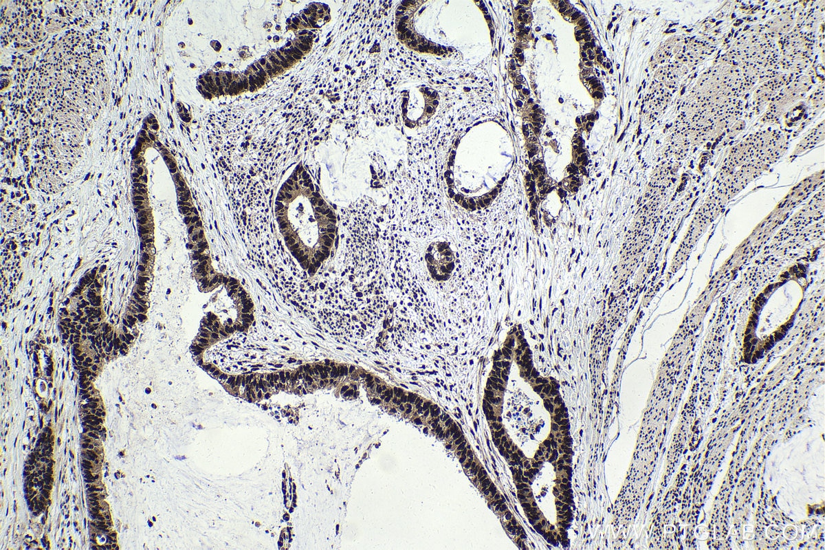 Immunohistochemical analysis of paraffin-embedded human urothelial carcinoma tissue slide using KHC1759 (BATF IHC Kit).