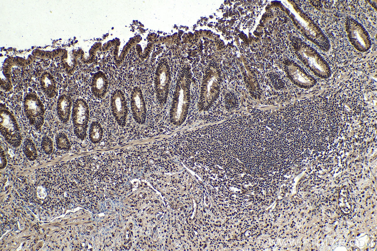 Immunohistochemical analysis of paraffin-embedded human appendicitis tissue slide using KHC1759 (BATF IHC Kit).