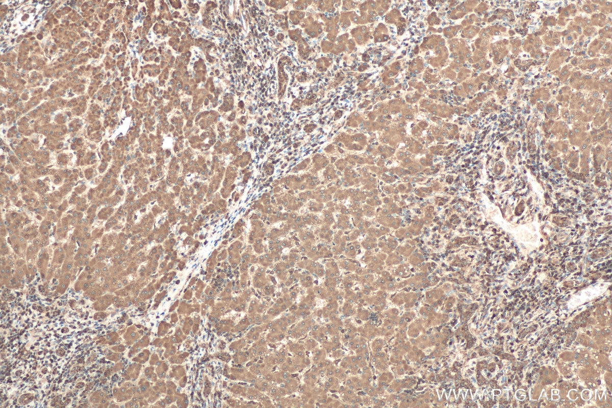 Immunohistochemical analysis of paraffin-embedded human liver cancer tissue slide using KHC0768 (BAX IHC Kit).