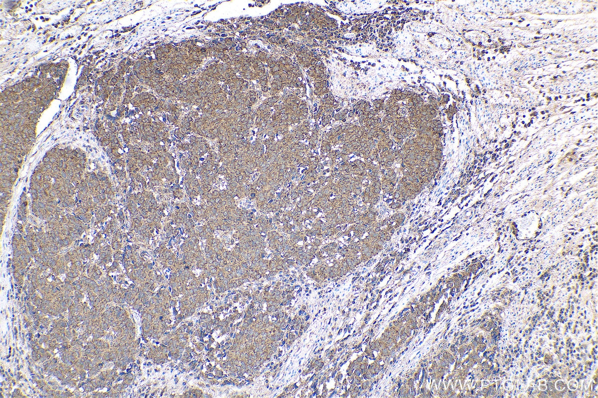 Immunohistochemical analysis of paraffin-embedded human stomach cancer tissue slide using KHC0768 (BAX IHC Kit).