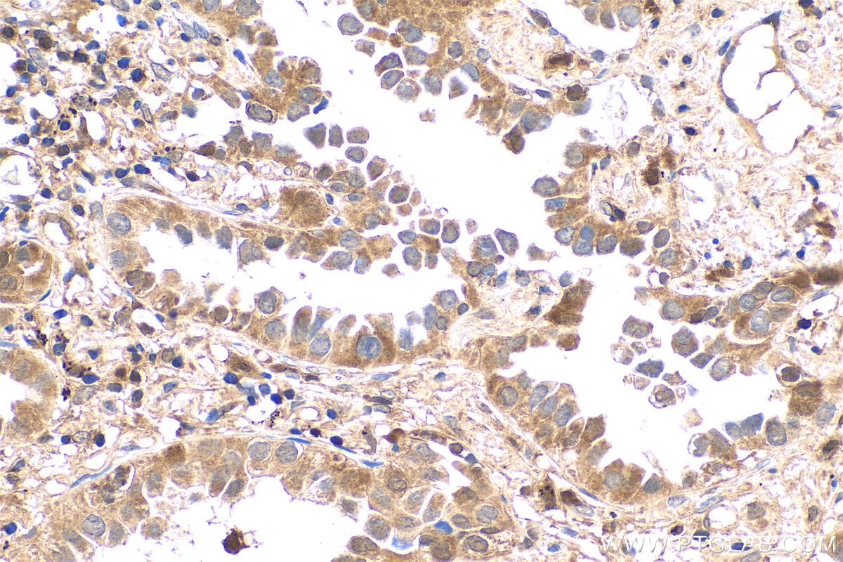 Immunohistochemical analysis of paraffin-embedded human lung cancer tissue slide using KHC0768 (BAX IHC Kit).