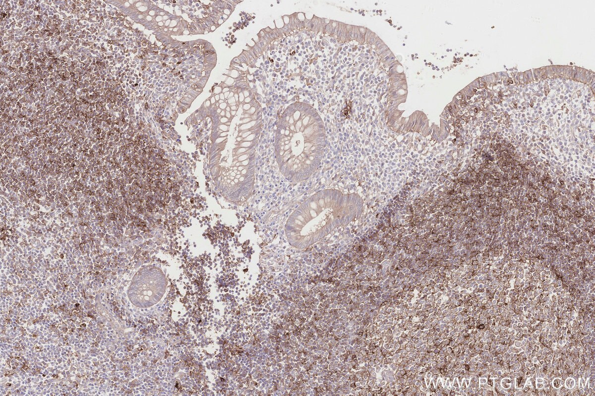 Immunohistochemical analysis of paraffin-embedded human appendicitis tissue slide using KHC2826 (BBS4 IHC Kit).