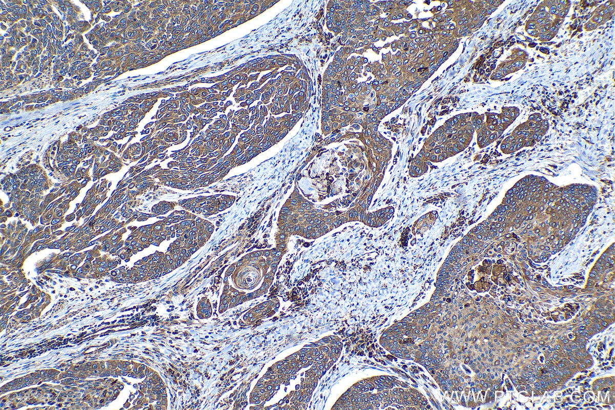 Immunohistochemical analysis of paraffin-embedded human oesophagus cancer tissue slide using KHC1355 (BCAP31 IHC Kit).