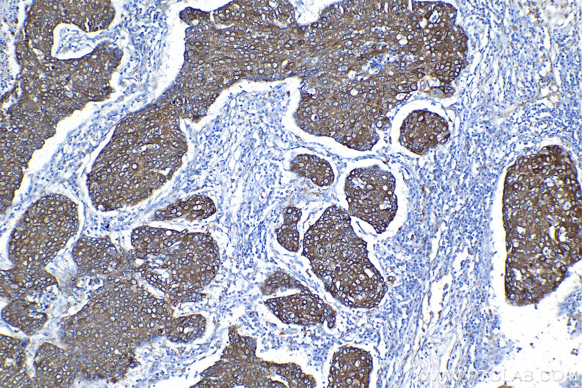 Immunohistochemical analysis of paraffin-embedded human lung cancer tissue slide using KHC1355 (BCAP31 IHC Kit).