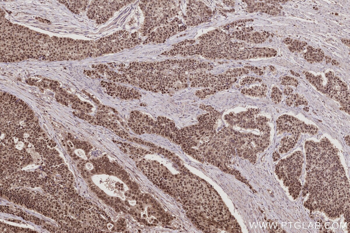 Immunohistochemical analysis of paraffin-embedded human stomach cancer tissue slide using KHC2990 (BCCIP IHC Kit).