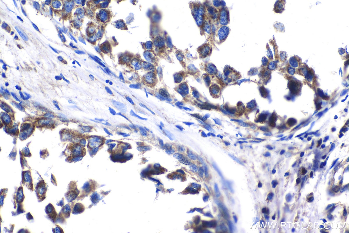 Immunohistochemical analysis of paraffin-embedded human breast cancer tissue slide using KHC1411 (BCKDHA IHC Kit).
