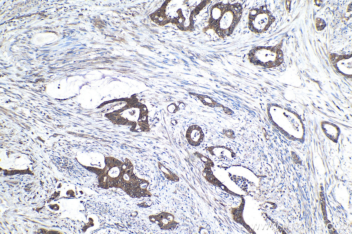 Immunohistochemical analysis of paraffin-embedded human urothelial carcinoma tissue slide using KHC1502 (BCL10 IHC Kit).