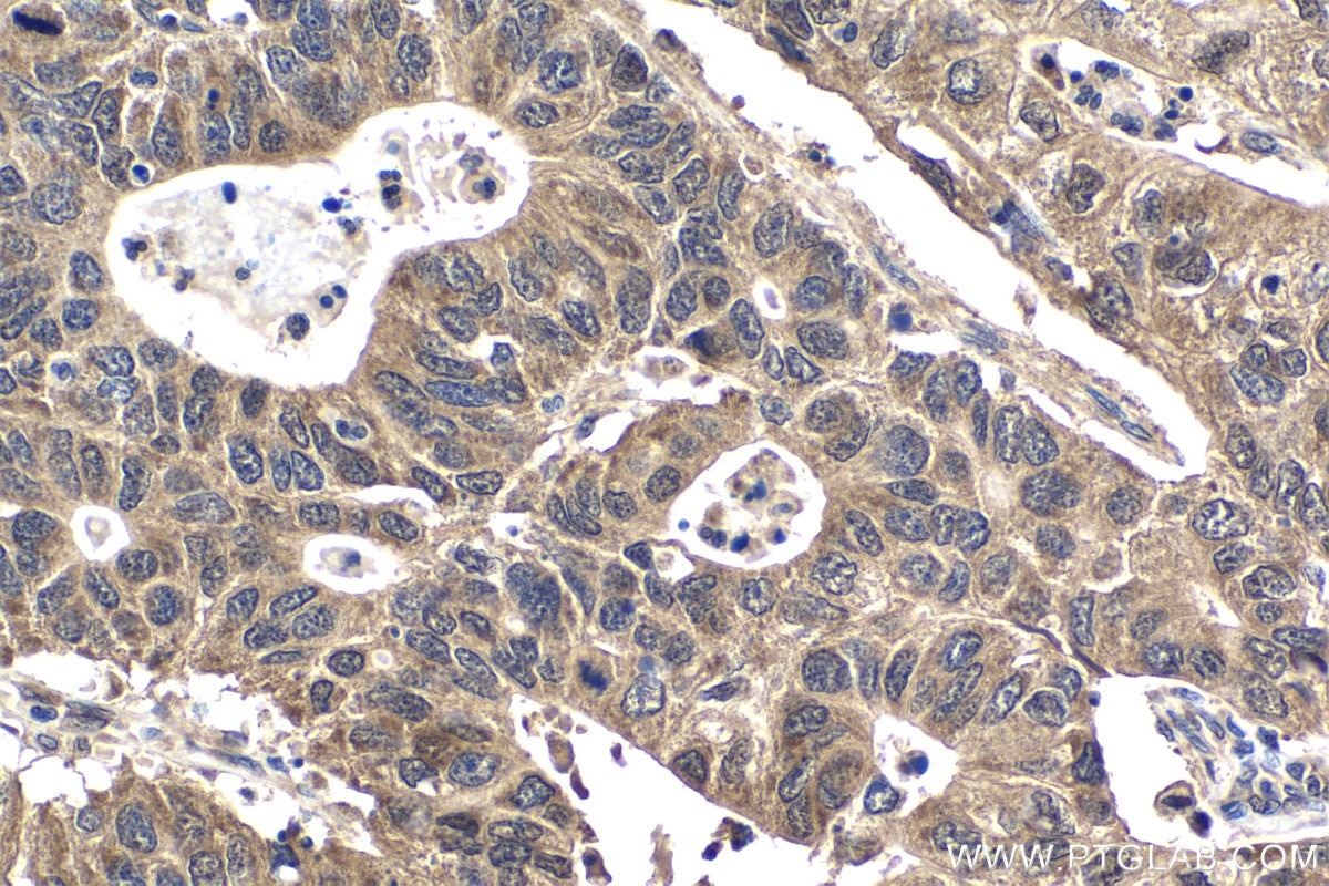 Immunohistochemical analysis of paraffin-embedded human stomach cancer tissue slide using KHC1502 (BCL10 IHC Kit).