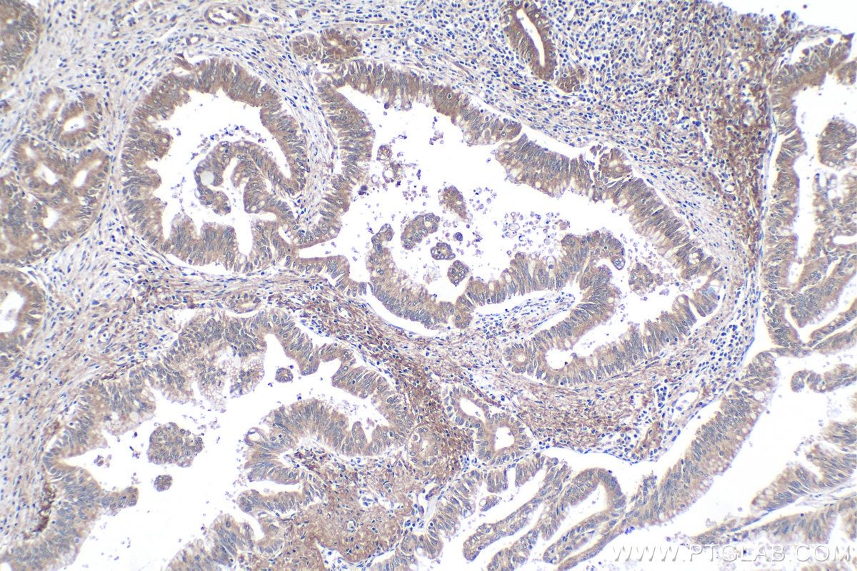 Immunohistochemical analysis of paraffin-embedded human pancreas cancer tissue slide using KHC1923 (BCL11A IHC Kit).