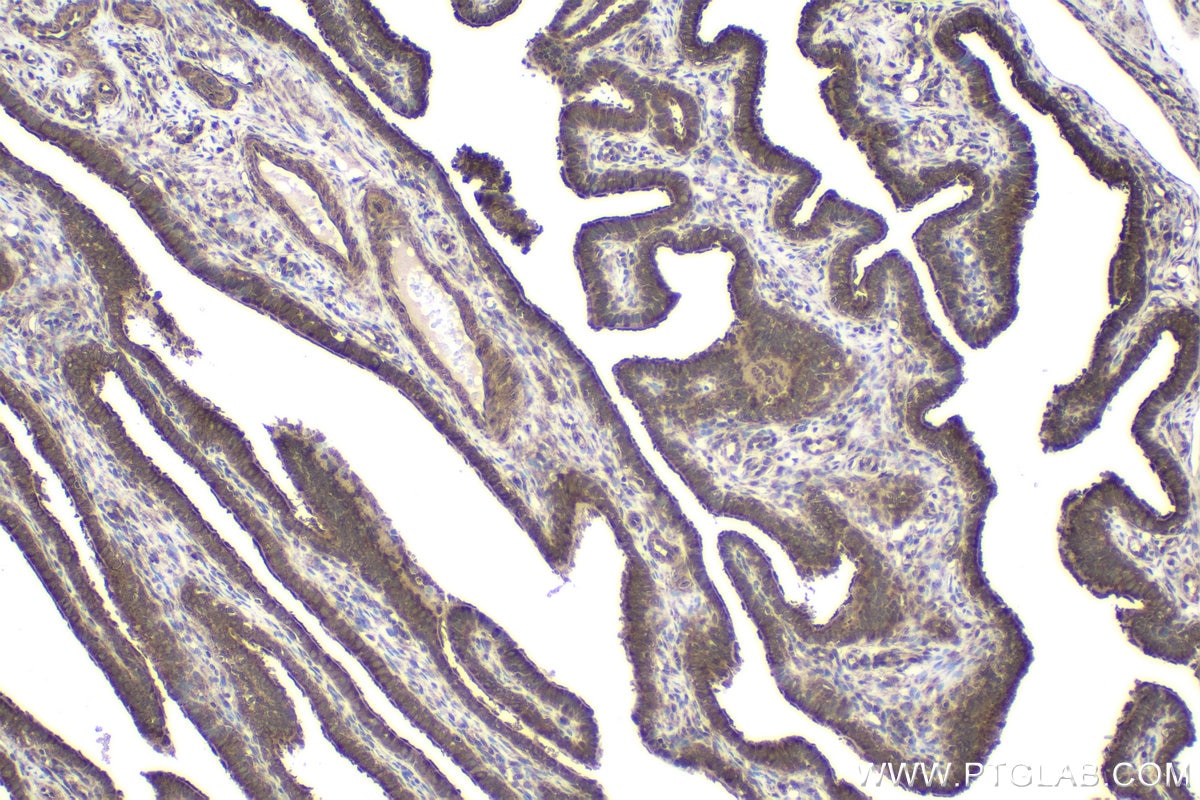 Immunohistochemical analysis of paraffin-embedded human ovary tumor tissue slide using KHC1923 (BCL11A IHC Kit).
