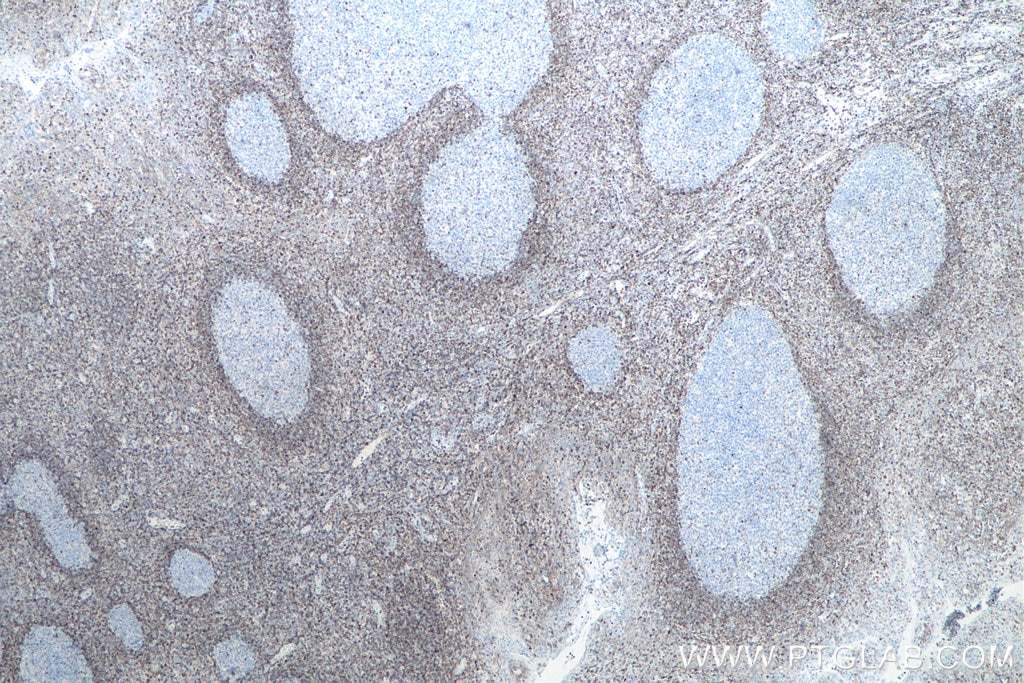 Immunohistochemical analysis of paraffin-embedded human tonsillitis tissue slide using KHC0012 (BCL2 IHC Kit).