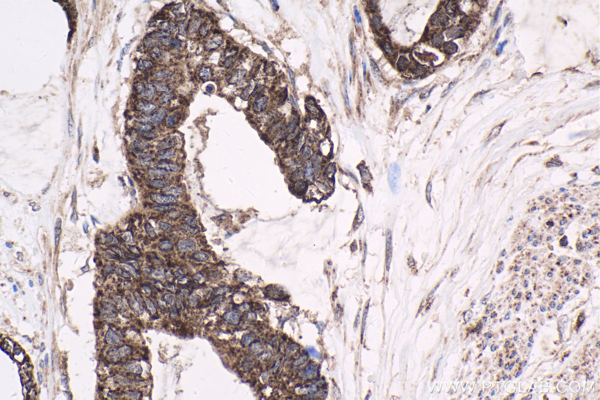 Immunohistochemical analysis of paraffin-embedded human urothelial carcinoma tissue slide using KHC1684 (BCL2L1 IHC Kit).