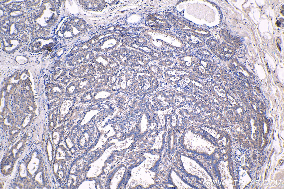 Immunohistochemical analysis of paraffin-embedded human breast cancer tissue slide using KHC1413 (BCL2L2 IHC Kit).