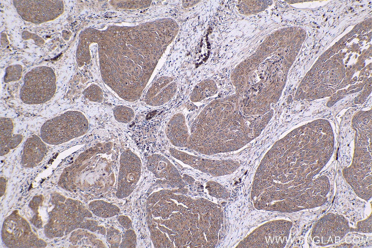 Immunohistochemical analysis of paraffin-embedded human oesophagus cancer tissue slide using KHC1413 (BCL2L2 IHC Kit).