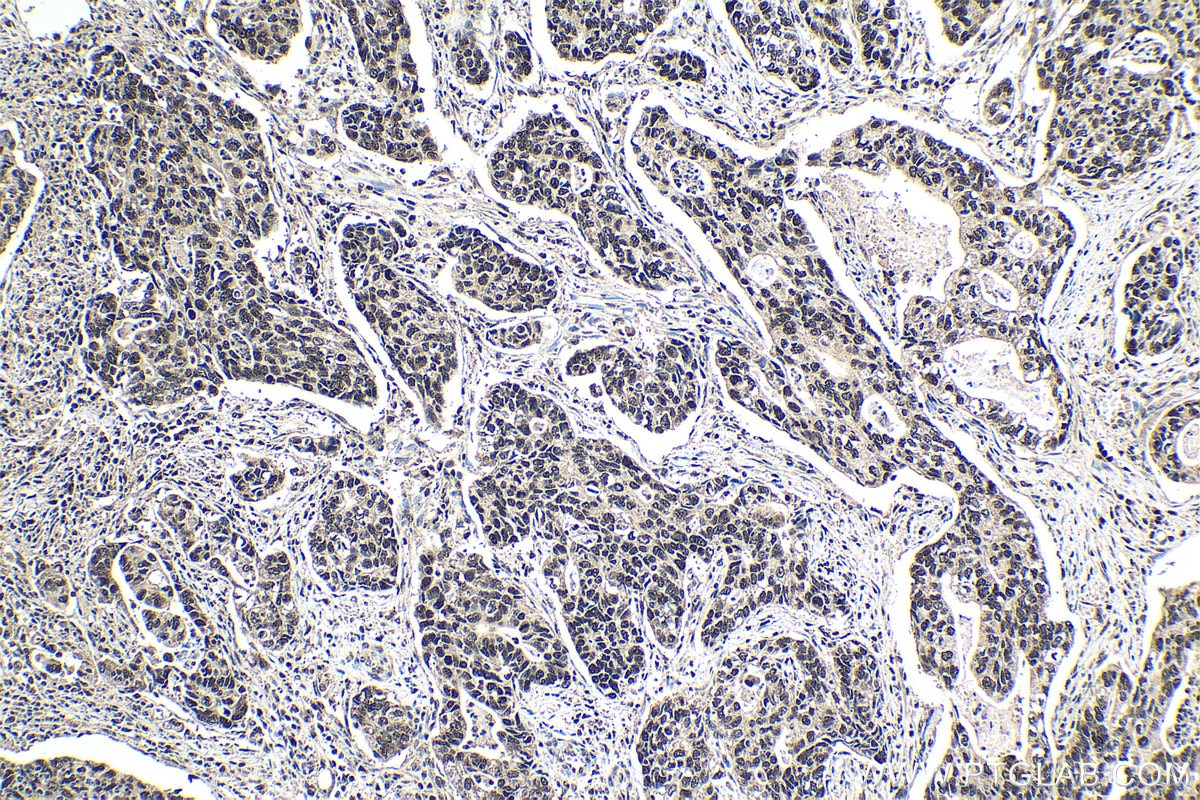 Immunohistochemical analysis of paraffin-embedded human stomach cancer tissue slide using KHC1376 (BCLAF1 IHC Kit).