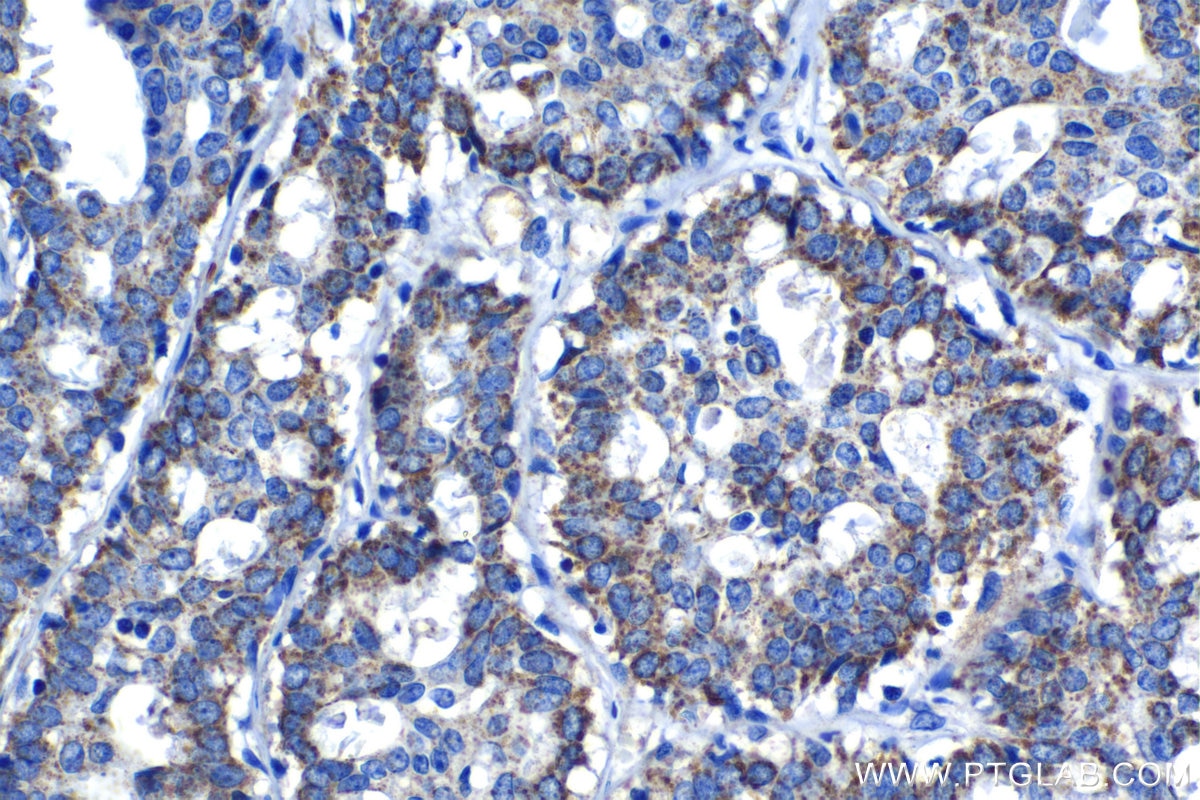 Immunohistochemical analysis of paraffin-embedded human breast cancer tissue slide using KHC1356 (BDH1 IHC Kit).