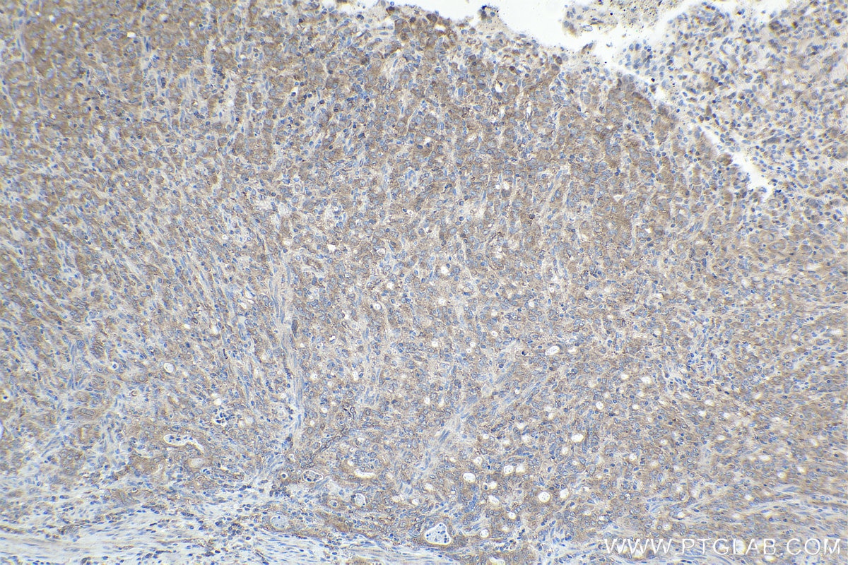 Immunohistochemical analysis of paraffin-embedded human stomach cancer tissue slide using KHC1731 (BECN1 IHC Kit).