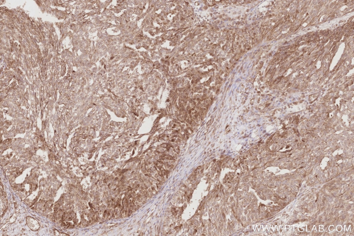 Immunohistochemical analysis of paraffin-embedded human ovary cancer tissue slide using KHC2884 (BEX1/2 IHC Kit). Immunohistochemical analysis of paraffin-embedded human ovary cancer tissue slide using KHC2884 (BEX1/2 IHC Kit).