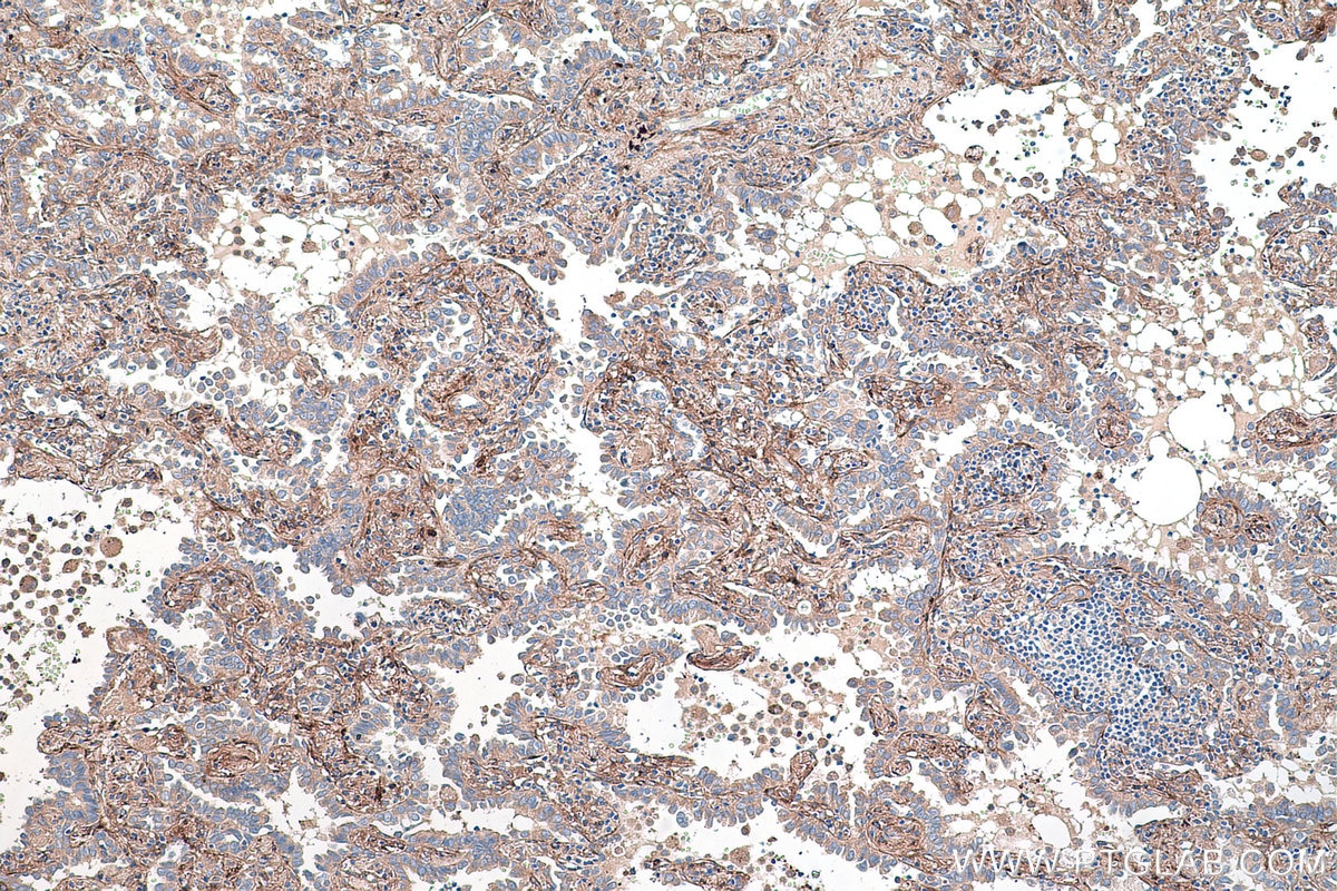 Immunohistochemical analysis of paraffin-embedded human lung cancer tissue slide using KHC0480 (BGN/Biglycan IHC Kit).