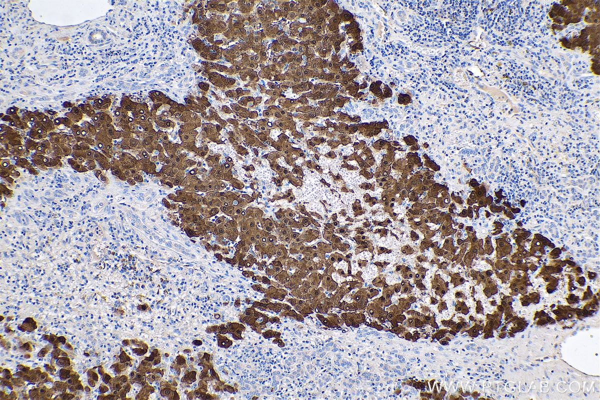 Immunohistochemical analysis of paraffin-embedded human liver cancer tissue slide using KHC0515 (BHMT IHC Kit).