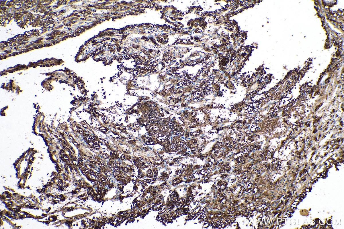 Immunohistochemical analysis of paraffin-embedded human renal cell carcinoma tissue slide using KHC0515 (BHMT IHC Kit).