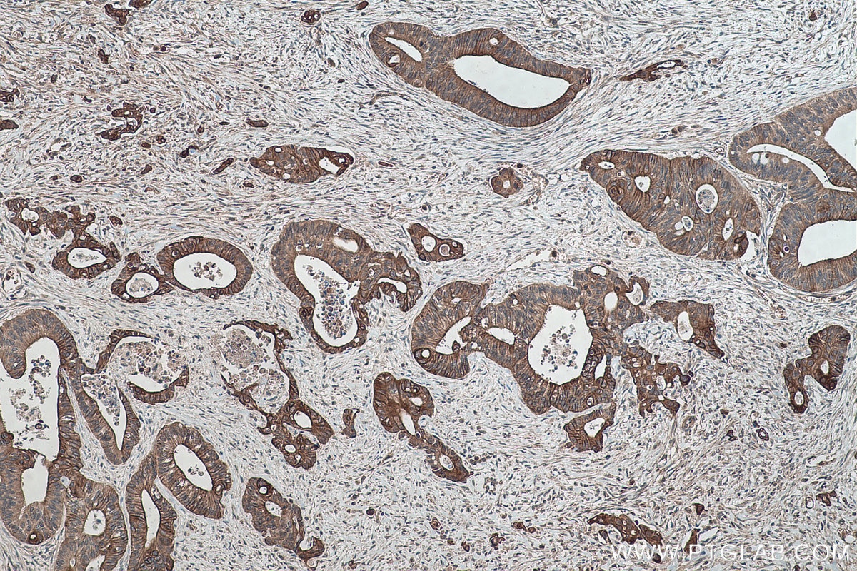 Immunohistochemical analysis of paraffin-embedded human colon cancer tissue slide using KHC0403 (BID IHC Kit).