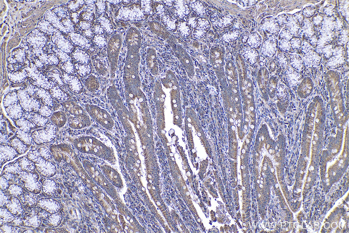 Immunohistochemical analysis of paraffin-embedded human stomach cancer tissue slide using KHC0620 (cIAP1 IHC Kit).